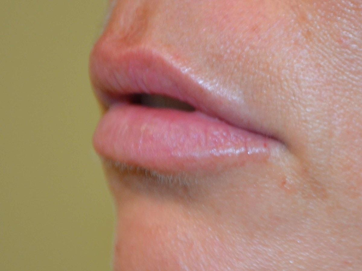 Kouris M.D. Cosmetic Plastic Surgery lip filler after — Hinsdale, IL