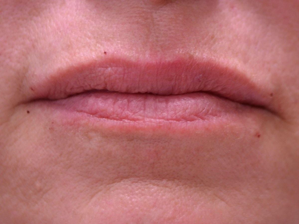 Kouris M.D. Cosmetic Plastic Surgery lip filler after — Hinsdale, IL