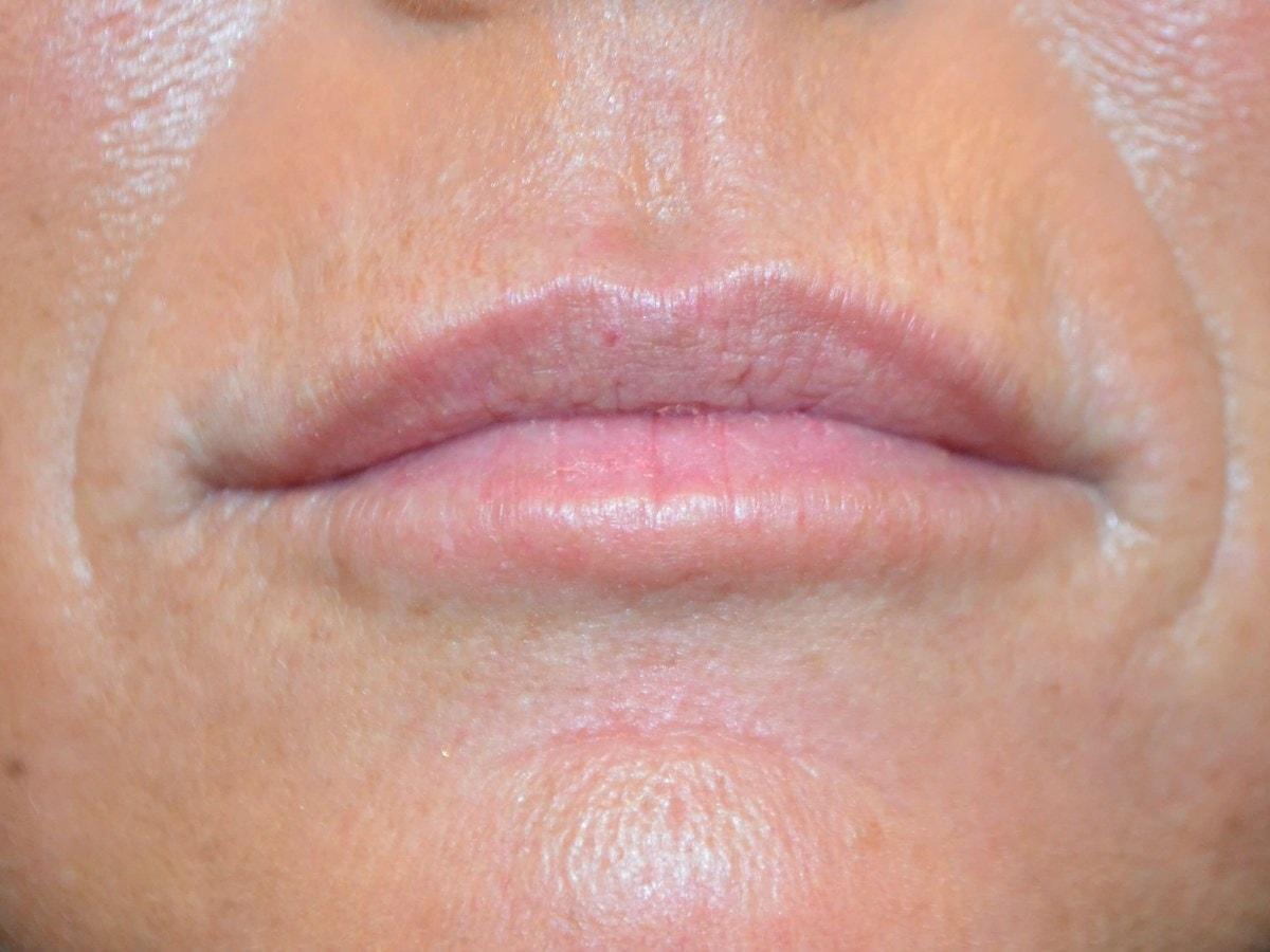 Kouris M.D. Cosmetic Plastic Surgery lip filler after — Hinsdale, IL