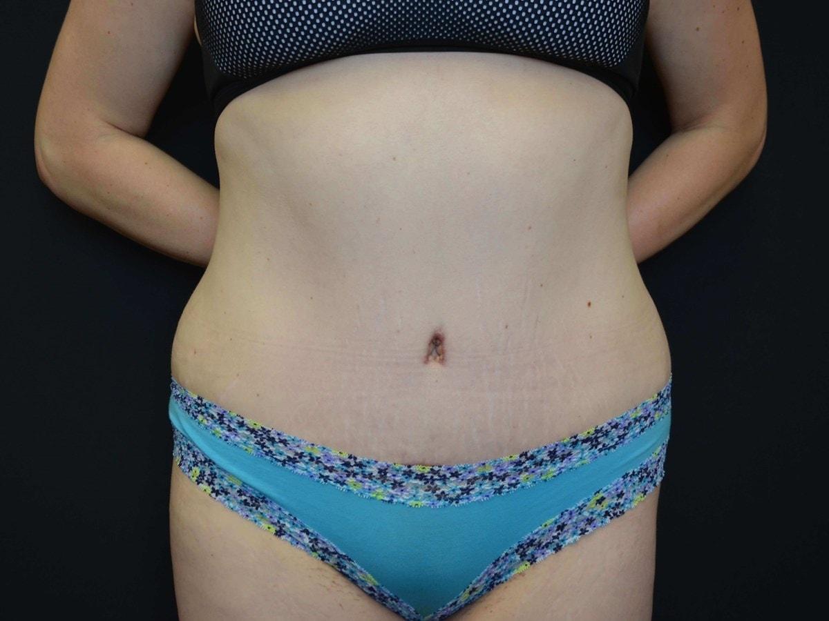 Kouris M.D. Cosmetic Plastic Surgery tummy tuck after — Hinsdale, IL