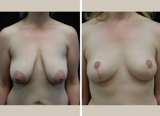 Breast Lift result at Flourish Surgical Arts in Denver, CO