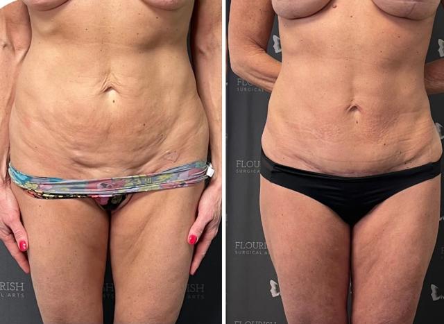 Tummy Tuck result at Flourish Surgical Arts in Denver, CO