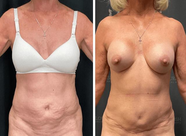 Mommy Makeover result at Flourish Surgical Arts in Denver, CO