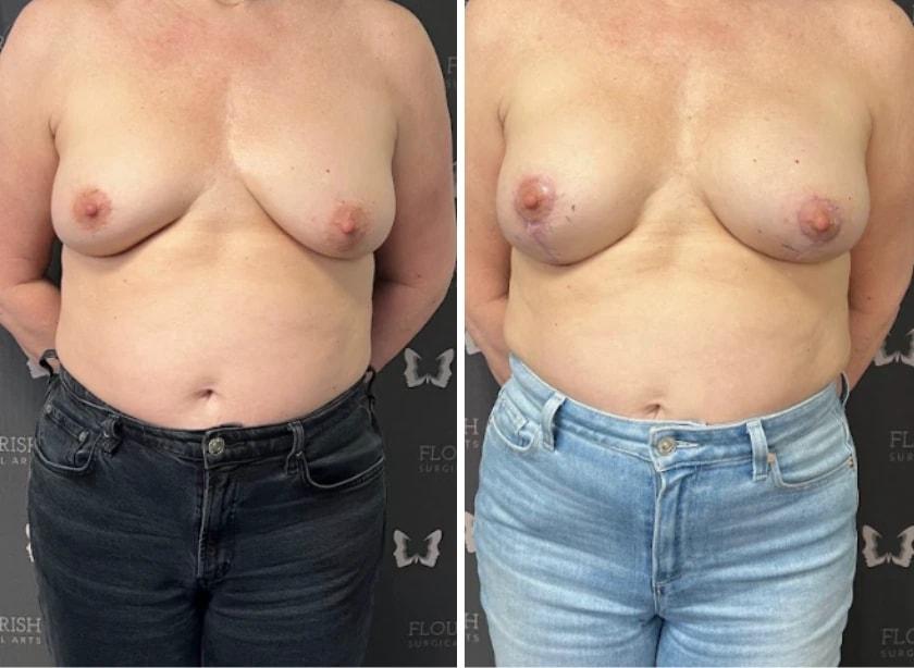 Flourish Surgical Arts breast augmentation result — Denver, CO
