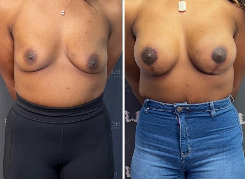 Flourish Surgical Arts breast augmentation result — Denver, CO