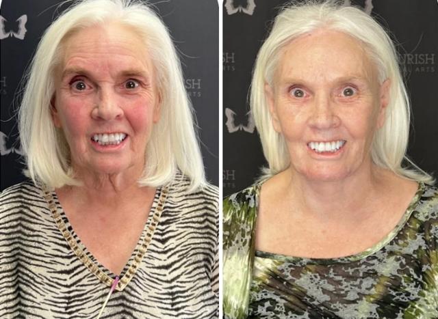 Neck Lift result at Flourish Surgical Arts in Denver, CO