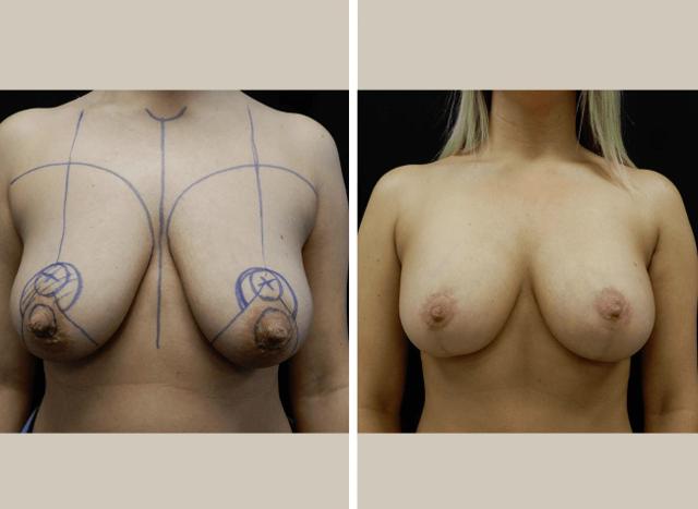Breast Lift result at Flourish Surgical Arts in Denver, CO