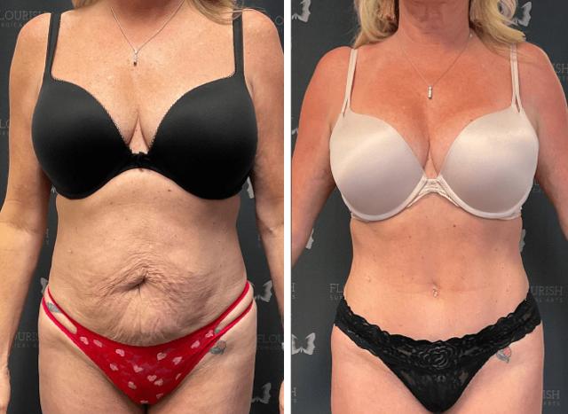 Tummy Tuck result at Flourish Surgical Arts in Denver, CO