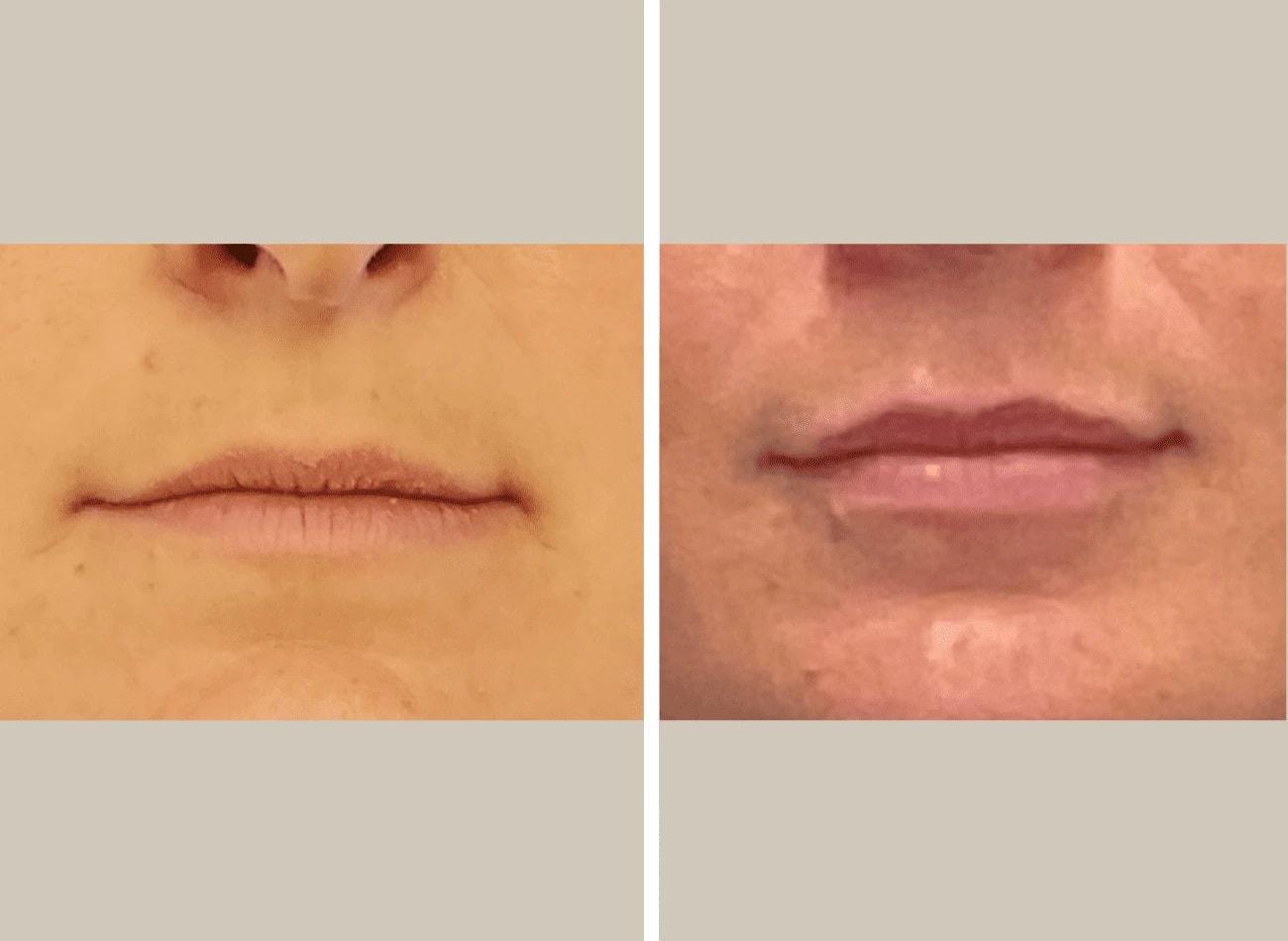 Flourish Surgical Arts lip filler result — Denver, CO