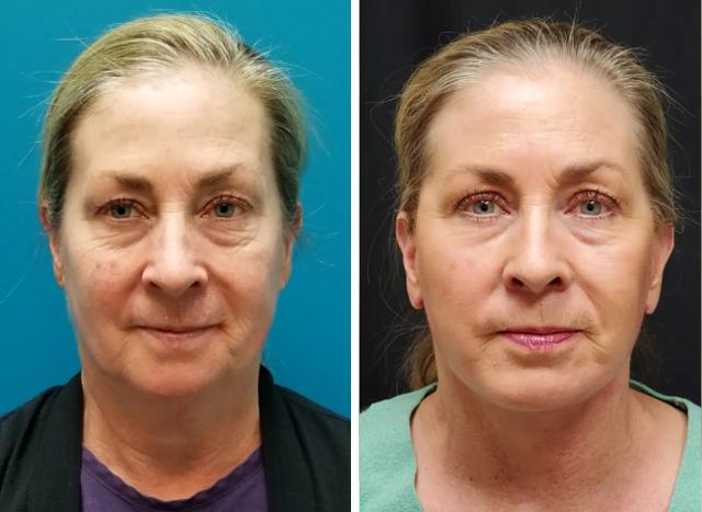 Neck Lift result at Flourish Surgical Arts in Denver, CO