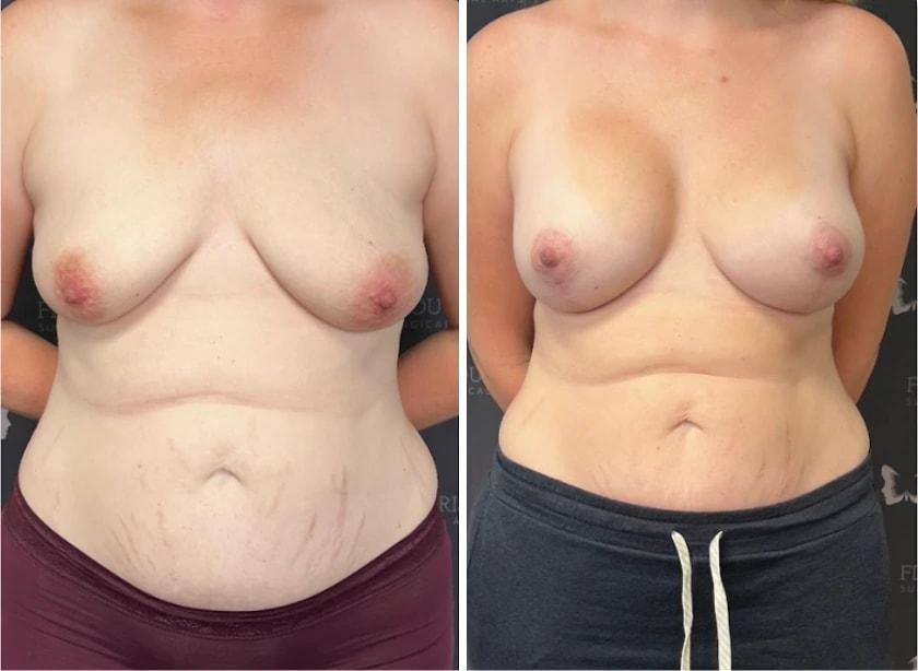Flourish Surgical Arts breast augmentation result — Denver, CO