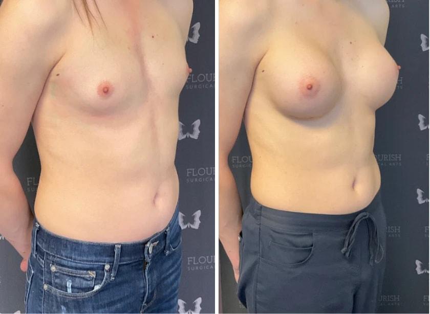 Flourish Surgical Arts breast augmentation result — Denver, CO