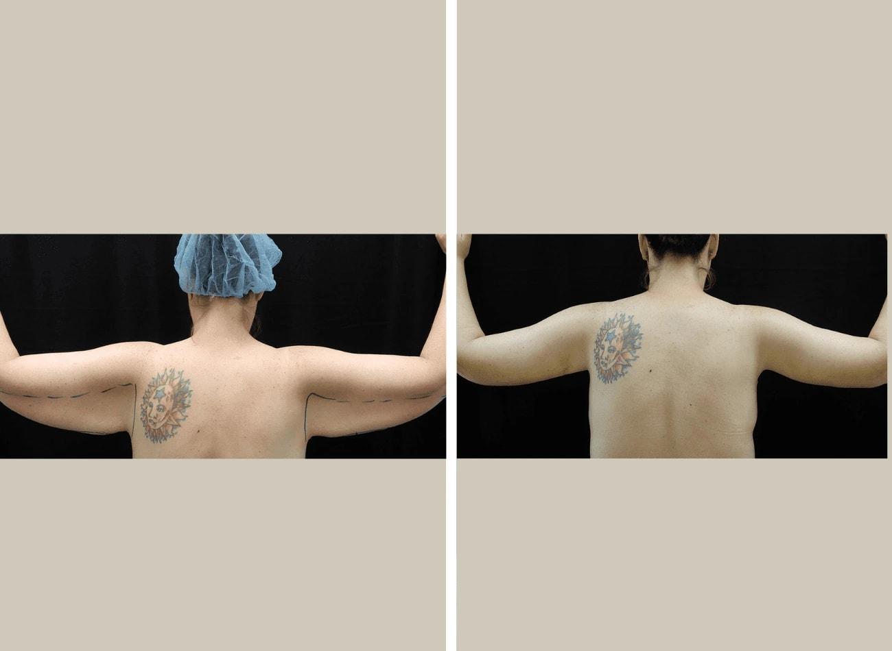Flourish Surgical Arts arm lift result — Denver, CO