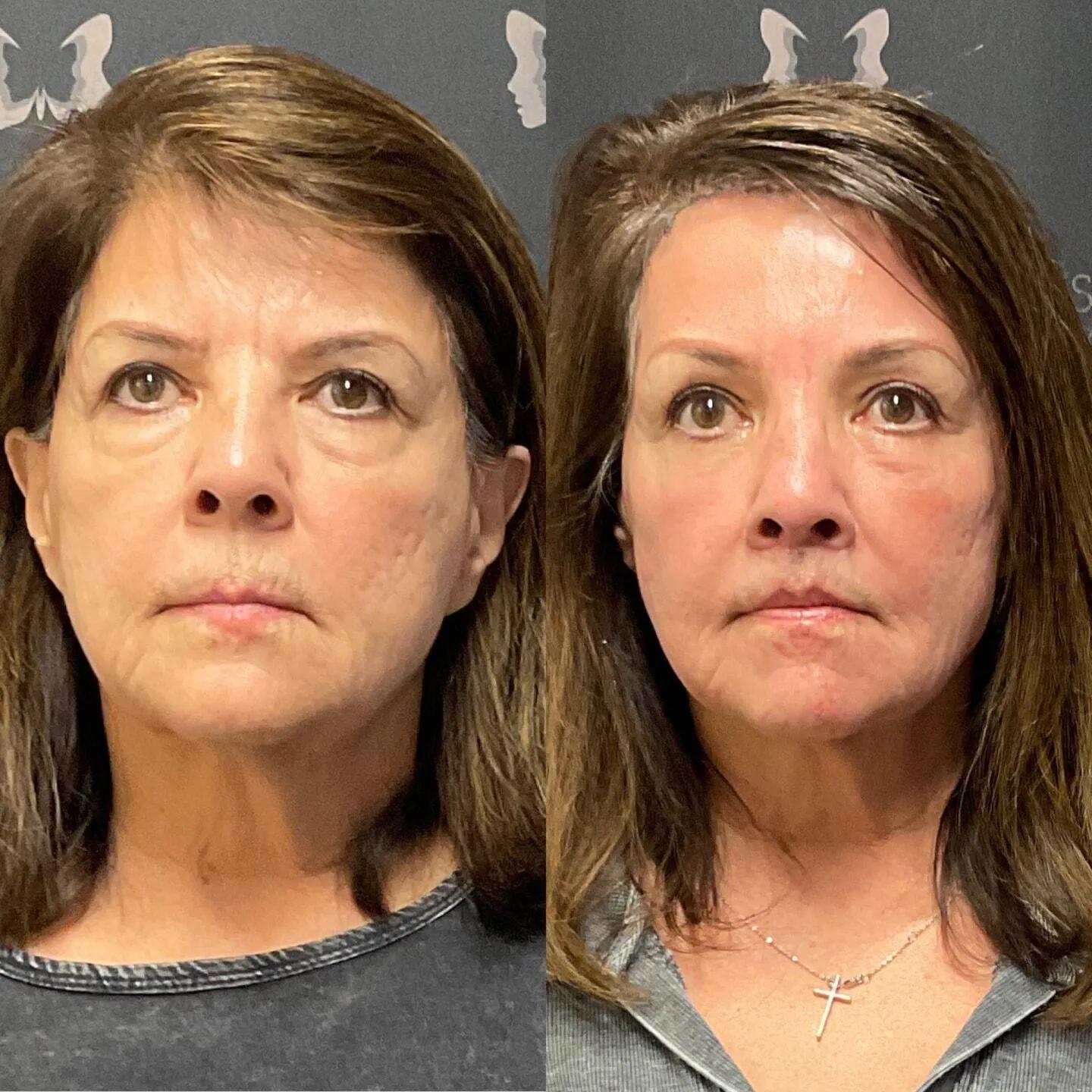 Flourish Surgical Arts fat transfer result — Denver, CO