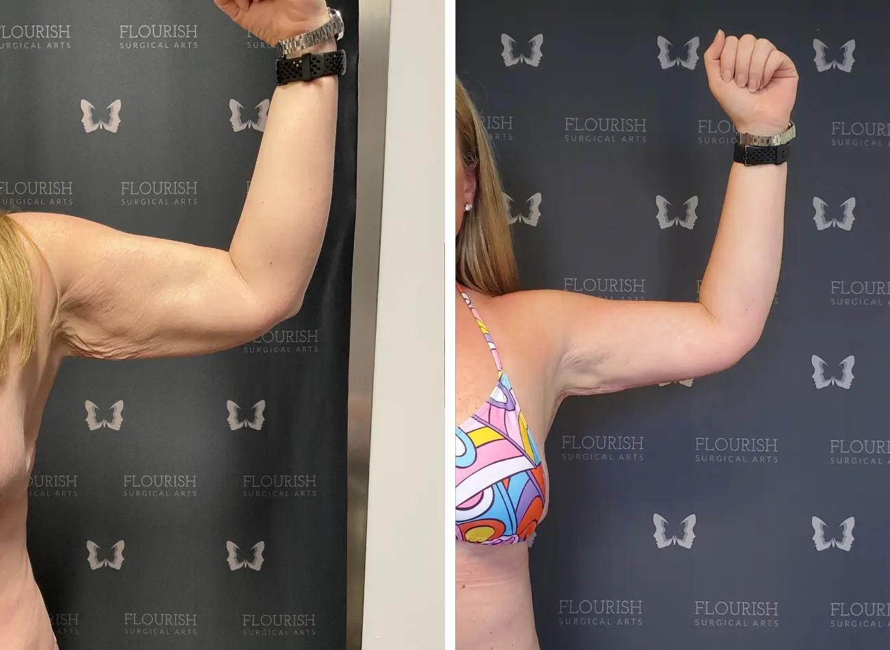 Flourish Surgical Arts arm lift result — Denver, CO