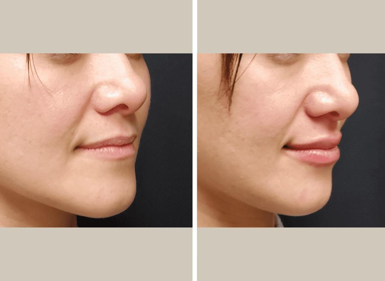 Flourish Surgical Arts lip filler result — Denver, CO