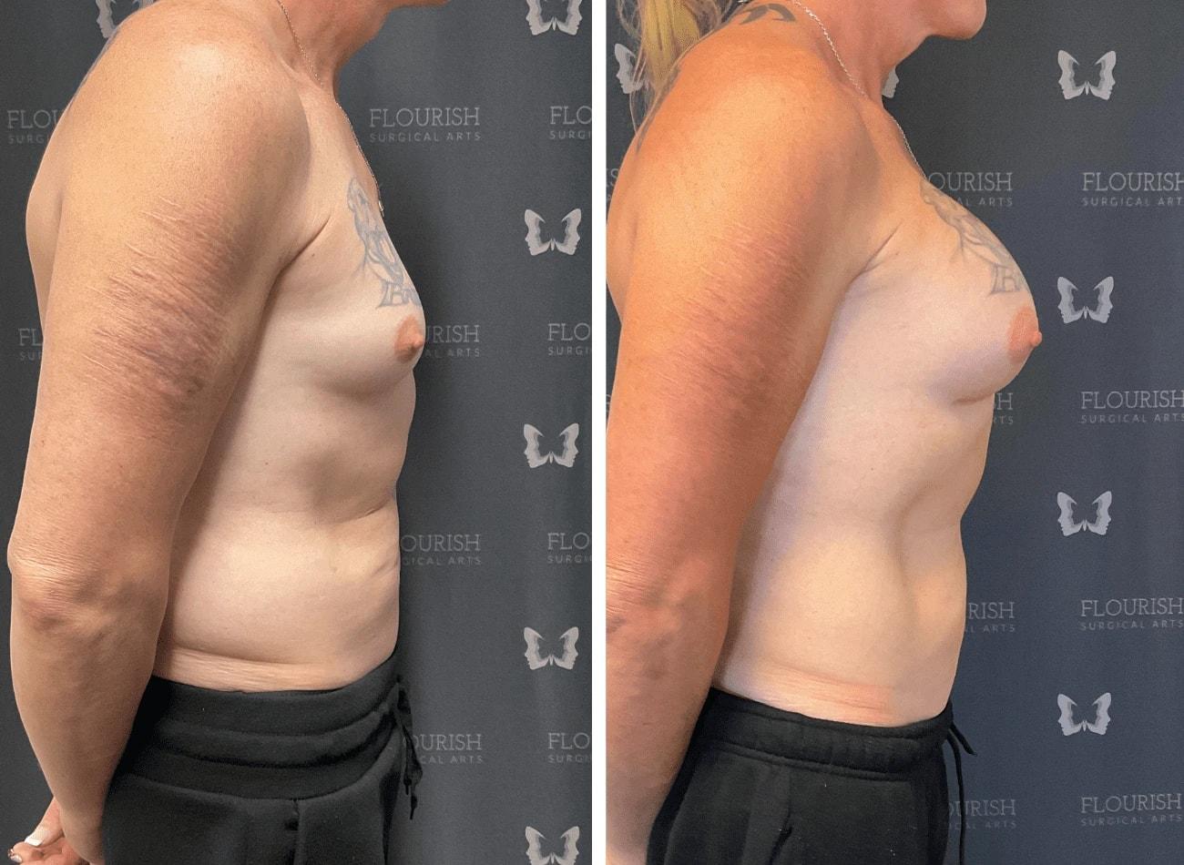 Flourish Surgical Arts breast augmentation result — Denver, CO