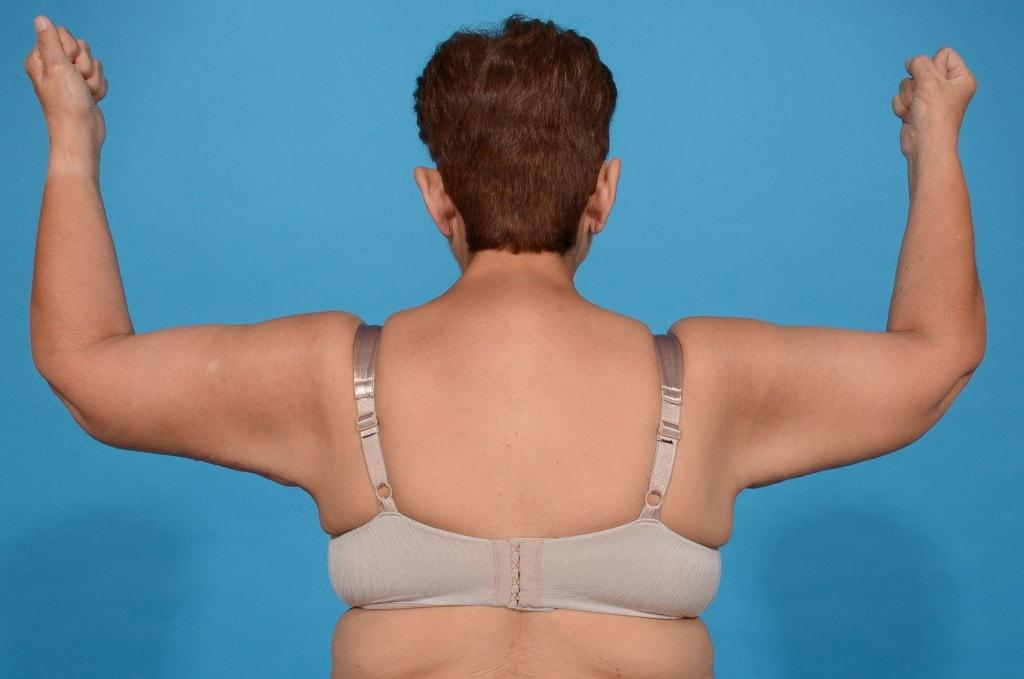 Ira Savetsky, MD arm lift after — New York, NY