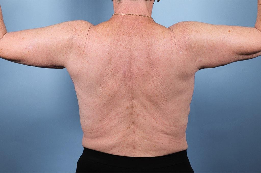 Ira Savetsky, MD arm lift after — New York, NY