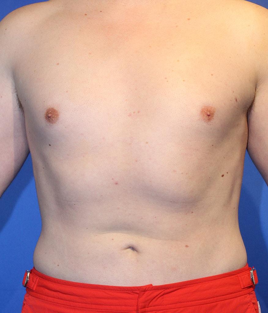 Ira Savetsky, MD liposuction after — New York, NY