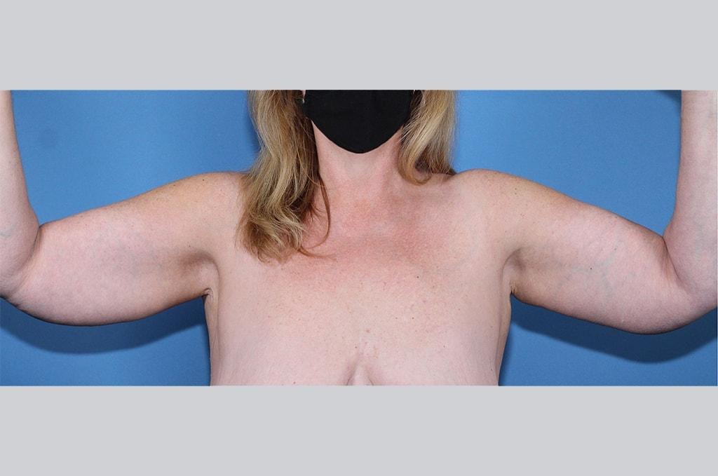 Ira Savetsky, MD arm lift after — New York, NY
