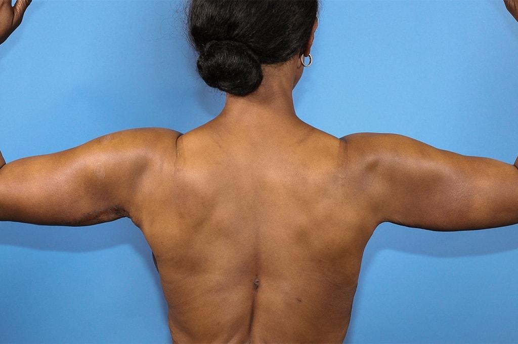 Ira Savetsky, MD arm lift after — New York, NY