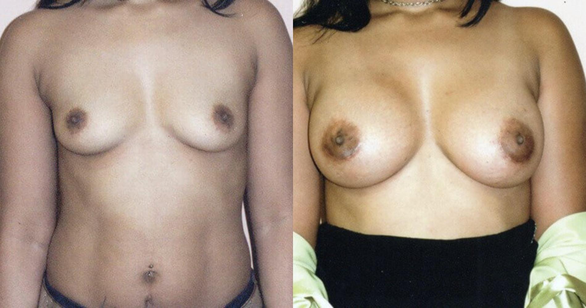 Center for Cosmetic & Reconstructive Surgery breast augmentation result — Atlanta, GA