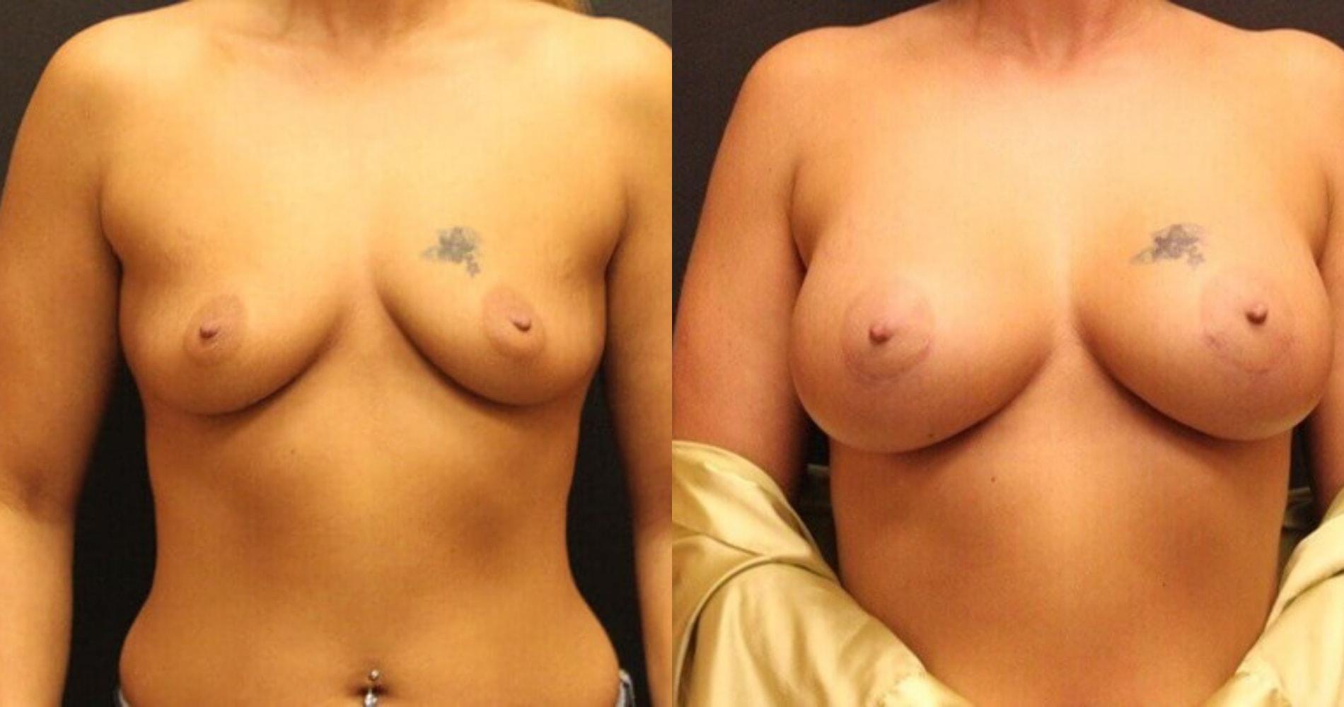 Center for Cosmetic & Reconstructive Surgery breast augmentation result — Atlanta, GA