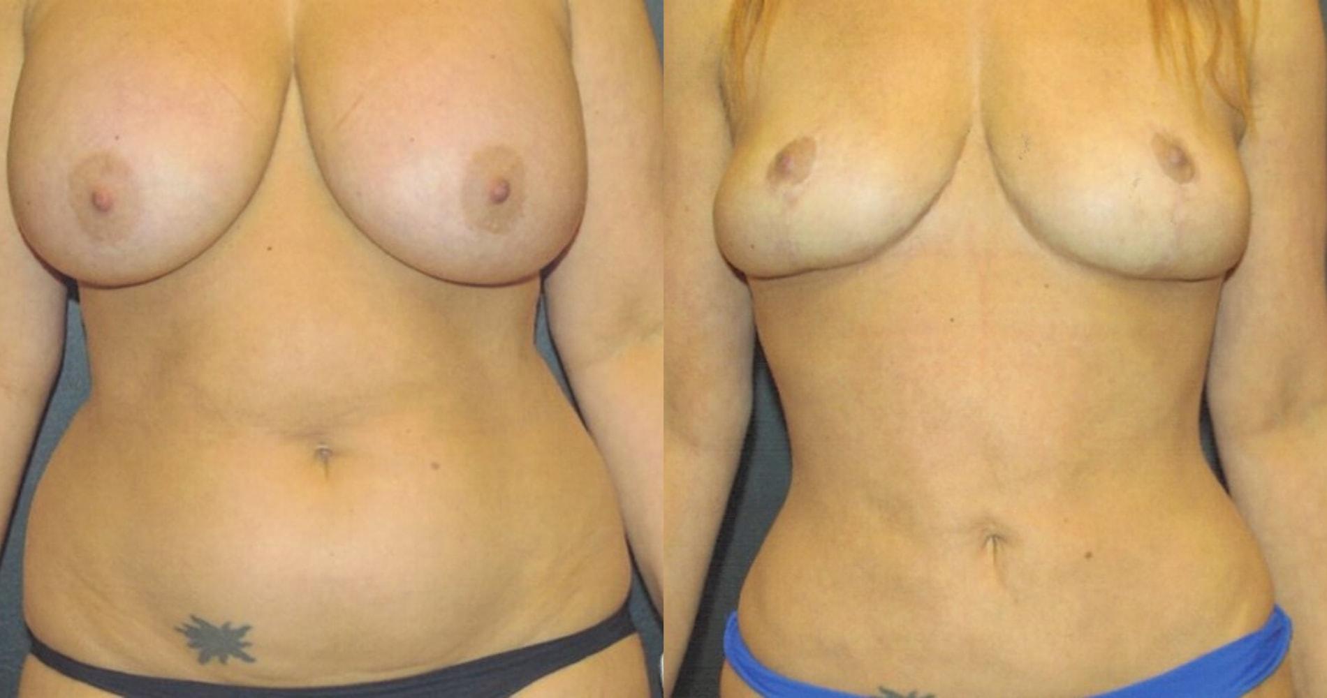 Center for Cosmetic & Reconstructive Surgery mommy makeover result — Atlanta, GA