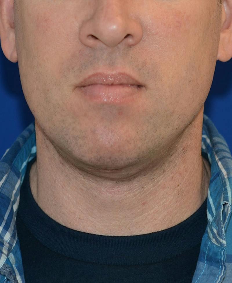 Congressional Plastic Surgery (Christopher C. Chang, MD) neck liposuction after — Vienna, VA