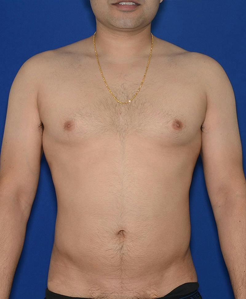 Congressional Plastic Surgery (Christopher C. Chang, MD) liposuction after — Vienna, VA