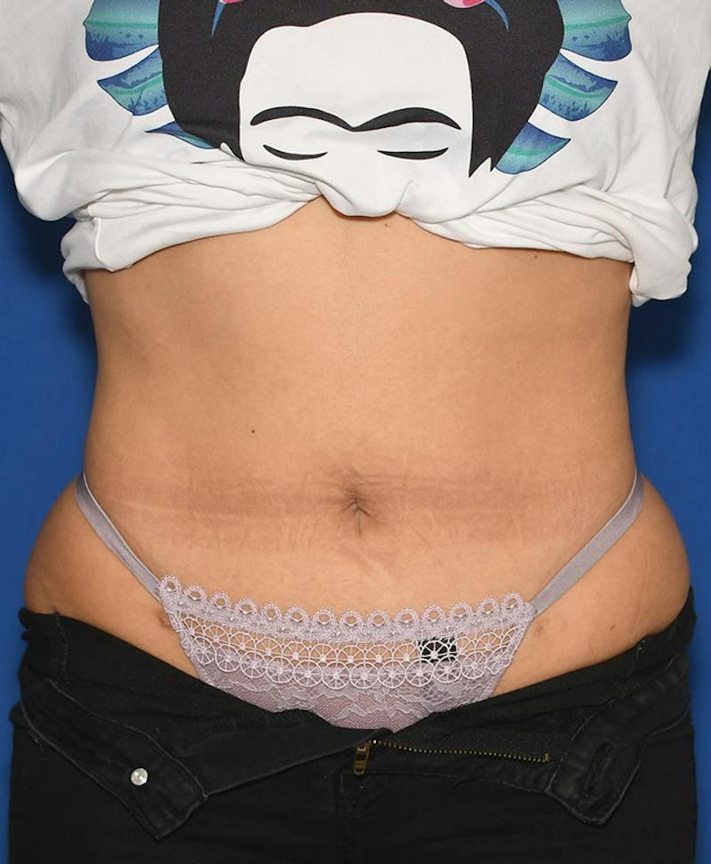 Congressional Plastic Surgery (Christopher C. Chang, MD) liposuction after — Vienna, VA