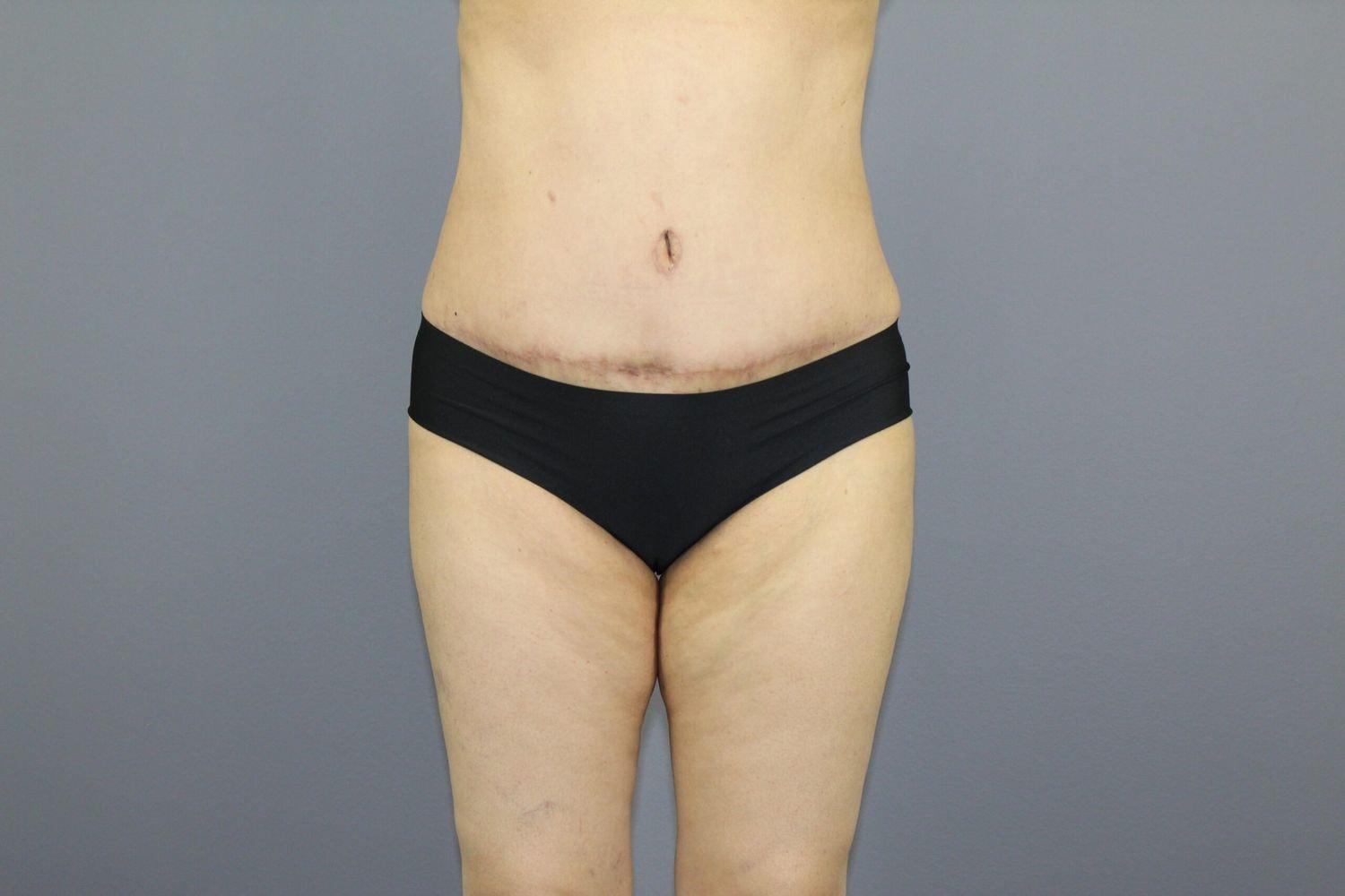 Leo Lapuerta, MD tummy tuck after — Pearland, TX