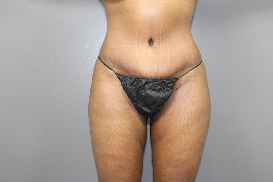 Leo Lapuerta, MD tummy tuck after — Pearland, TX