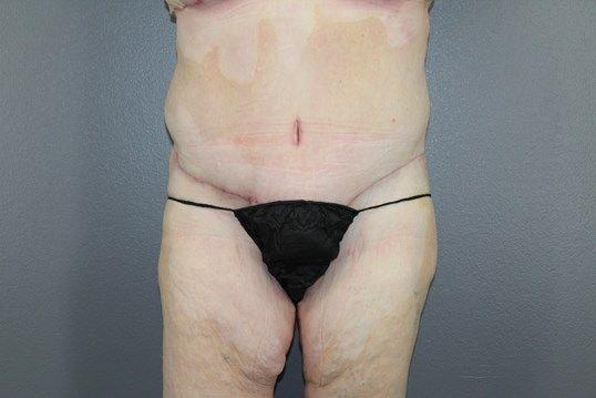 Leo Lapuerta, MD tummy tuck after — Pearland, TX