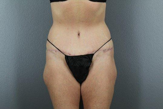Leo Lapuerta, MD tummy tuck after — Pearland, TX