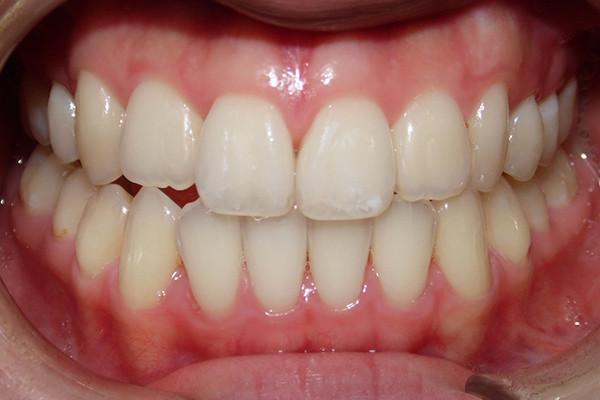 Smile Makeover after at Birch Dental in Newport Beach, CA