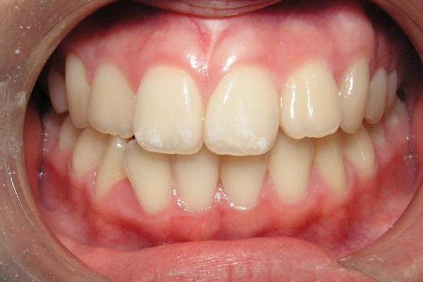Smile Makeover before at Birch Dental in Newport Beach, CA