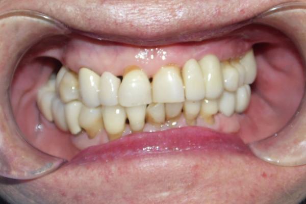 Dental Implants after at Birch Dental in Newport Beach, CA