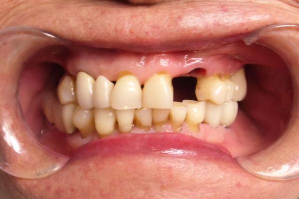 Dental Implants before at Birch Dental in Newport Beach, CA