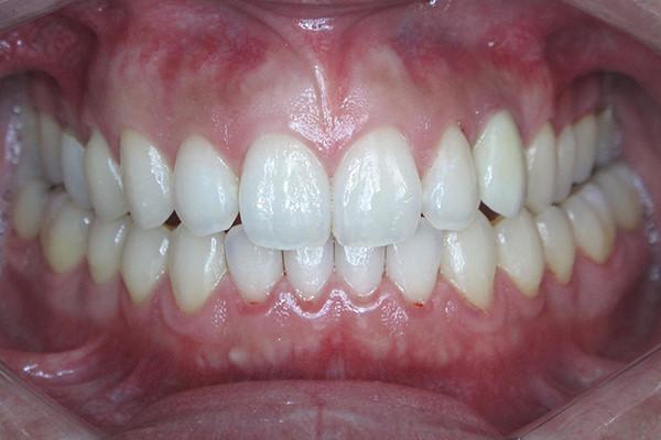 Birch Dental smile makeover after — Newport Beach, CA