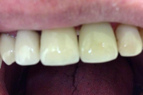 Dental Implants after at Birch Dental in Newport Beach, CA