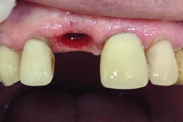 Dental Implants before at Birch Dental in Newport Beach, CA