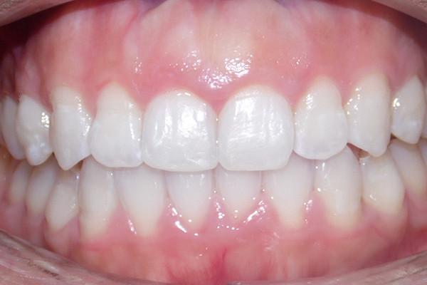 Birch Dental smile makeover after — Newport Beach, CA