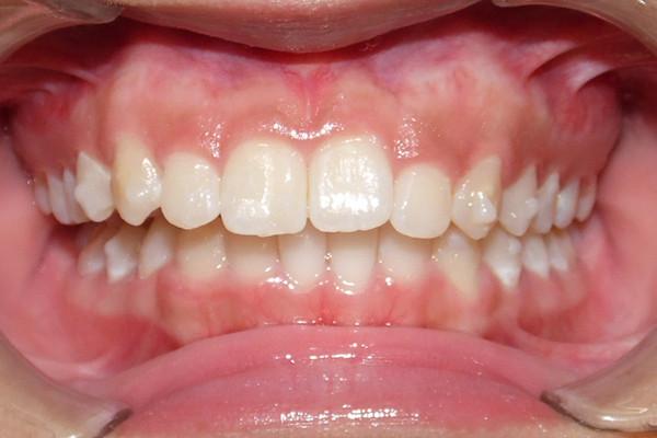 Smile Makeover after at Birch Dental in Newport Beach, CA