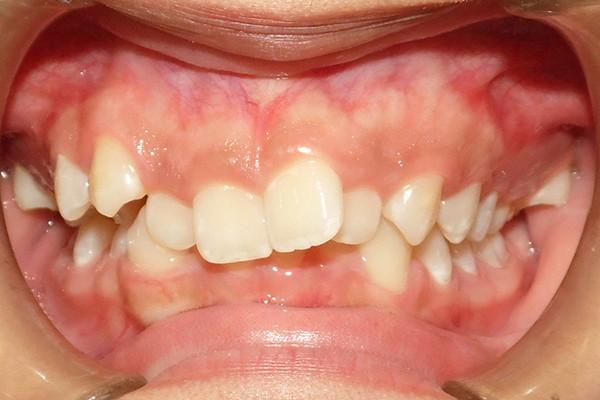 Smile Makeover before at Birch Dental in Newport Beach, CA