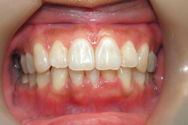 Invisalign after at Birch Dental in Newport Beach, CA