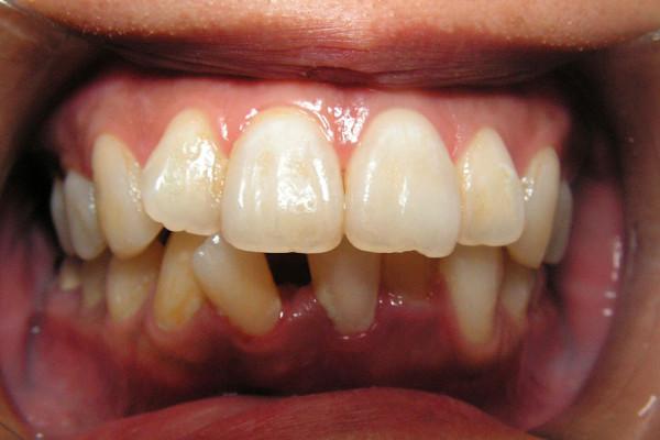 Invisalign before at Birch Dental in Newport Beach, CA