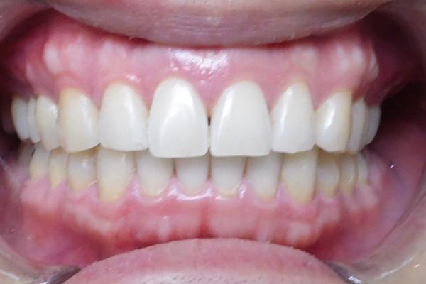 Birch Dental smile makeover after — Newport Beach, CA