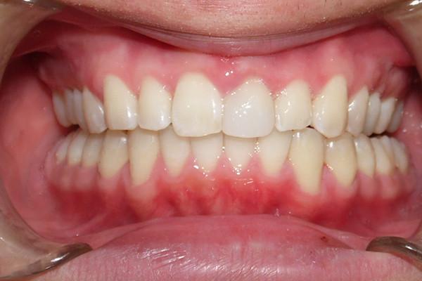 Birch Dental smile makeover after — Newport Beach, CA